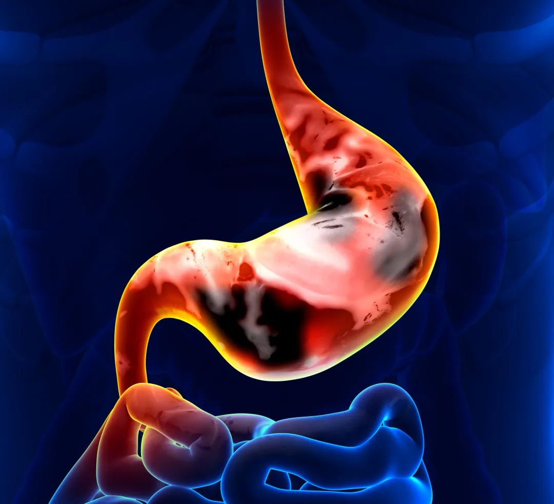 发现早期胃癌的5个细节-胃癌康复圈-觅健